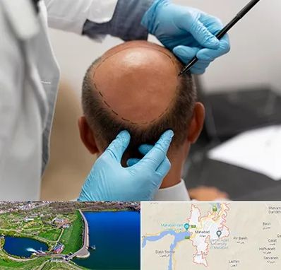 آموزش کاشت مو در مهاباد