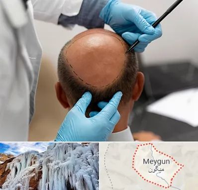 آموزش کاشت مو در میگون