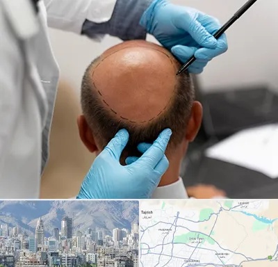 آموزش کاشت مو در شمال شرق تهران