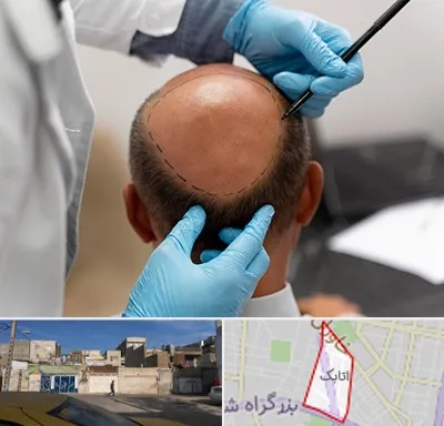 آموزش کاشت مو در اتابک