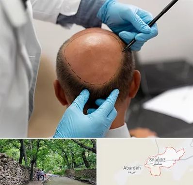 آموزش کاشت مو در شاندیز مشهد