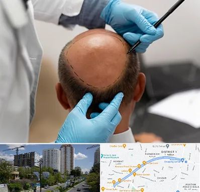 آموزش کاشت مو در اندرزگو 