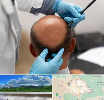آموزش کاشت مو در مرند