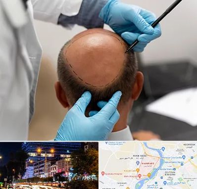 آموزش کاشت مو در کیانپارس اهواز 