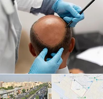 آموزش کاشت مو در کیانمهر کرج 