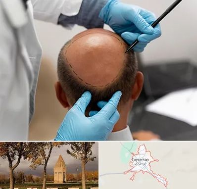 آموزش کاشت مو در تویسرکان