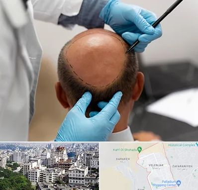 آموزش کاشت مو در ولنجک