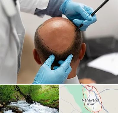 آموزش کاشت مو در نهاوند