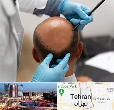 آموزش کاشت مو در صادقیه 