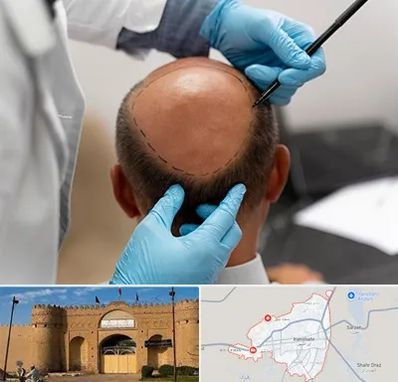 آموزش کاشت مو در ایرانشهر