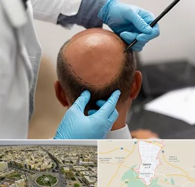 آموزش کاشت مو در قزوین