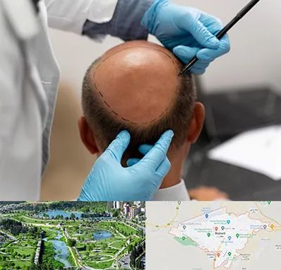 آموزش کاشت مو در بجنورد