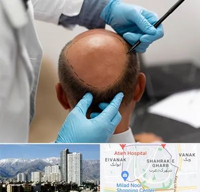 آموزش کاشت مو در شهرک غرب