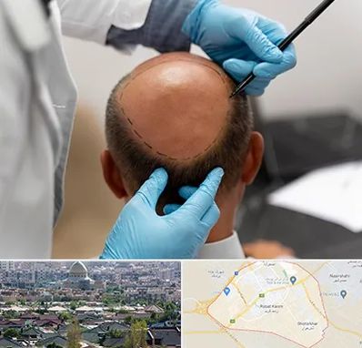 آموزش کاشت مو در رباط کریم