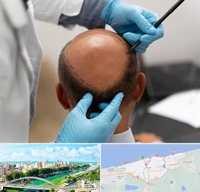 آموزش کاشت مو در بابلسر