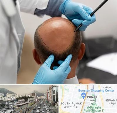 آموزش کاشت مو در پونک 