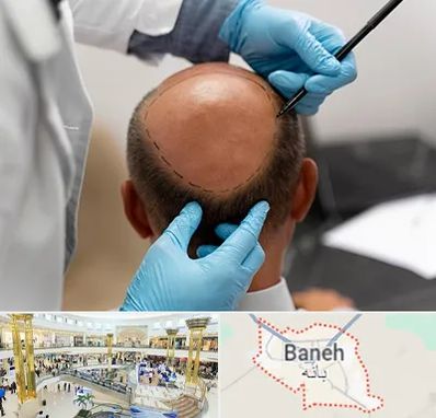 آموزش کاشت مو در بانه
