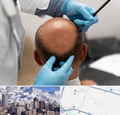 آموزش کاشت مو در ازگل