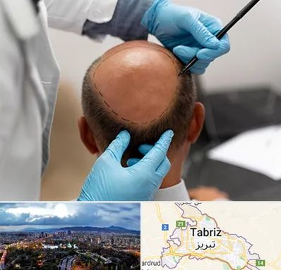 آموزش کاشت مو در تبریز