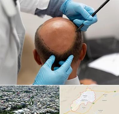 آموزش کاشت مو در شاهرود