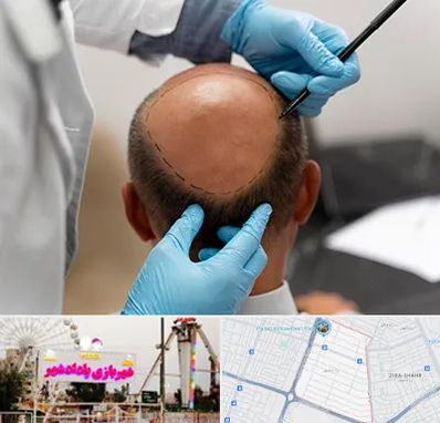 آموزش کاشت مو در پادادشهر اهواز