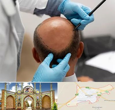 آموزش کاشت مو در سمنان