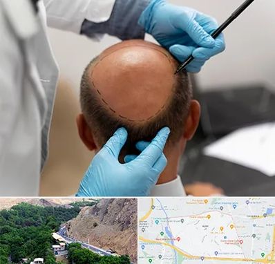 آموزش کاشت مو در کن 