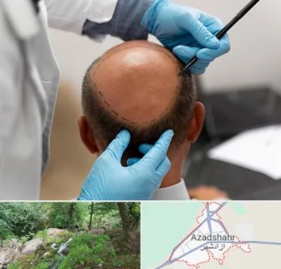 آموزش کاشت مو در آزادشهر