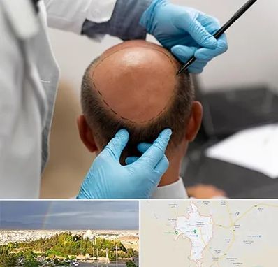 آموزش کاشت مو در تربت حیدریه