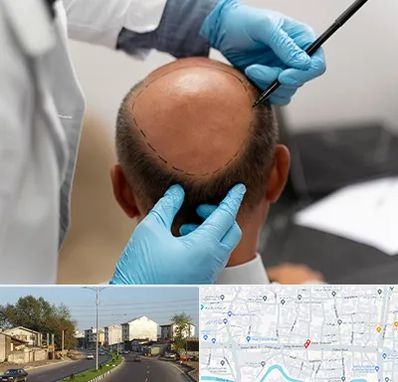 آموزش کاشت مو در ضیابری رشت 