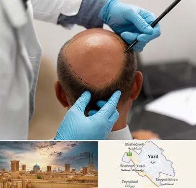 آموزش کاشت مو در یزد