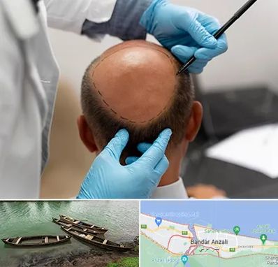 آموزش کاشت مو در بندر انزلی