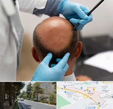 آموزش کاشت مو در مهرویلا کرج 