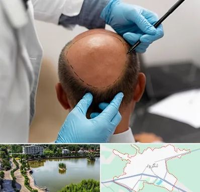 آموزش کاشت مو در لنگرود