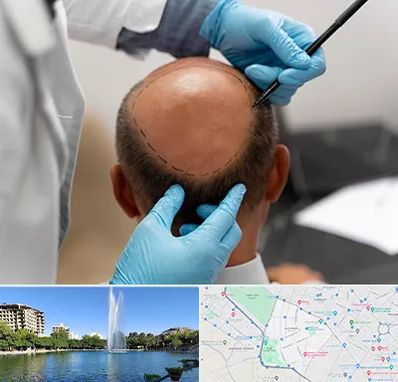 آموزش کاشت مو در کوهسنگی مشهد 