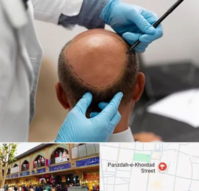 آموزش کاشت مو در 15 خرداد