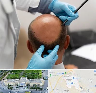 آموزش کاشت مو در نسیم شهر