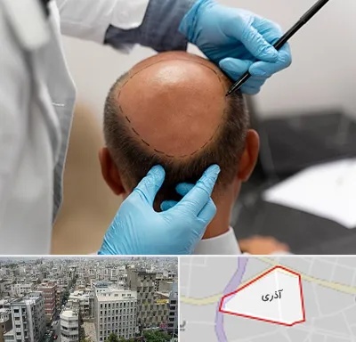 آموزش کاشت مو در آذری