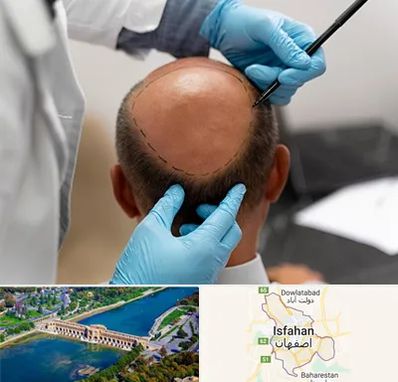 آموزش کاشت مو در اصفهان