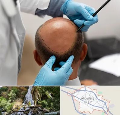 آموزش کاشت مو در الیگودرز