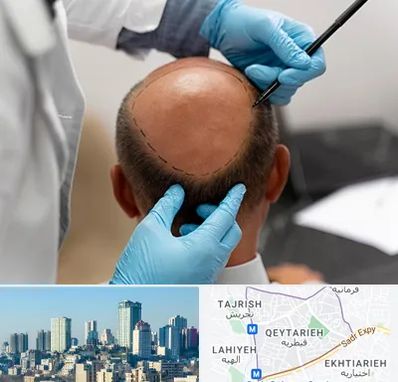 آموزش کاشت مو در قیطریه 