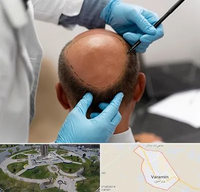 آموزش کاشت مو در ورامین