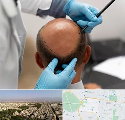 آموزش کاشت مو در نازی آباد 