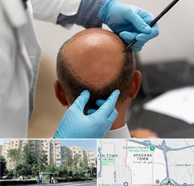 آموزش کاشت مو در آپادانا