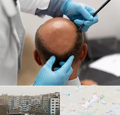 آموزش کاشت مو در محمد شهر کرج 