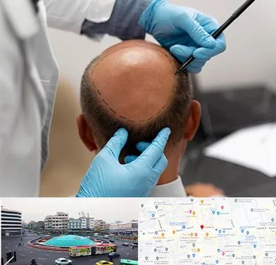 آموزش کاشت مو در میدان انقلاب 