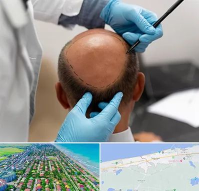 آموزش کاشت مو در فریدونکنار