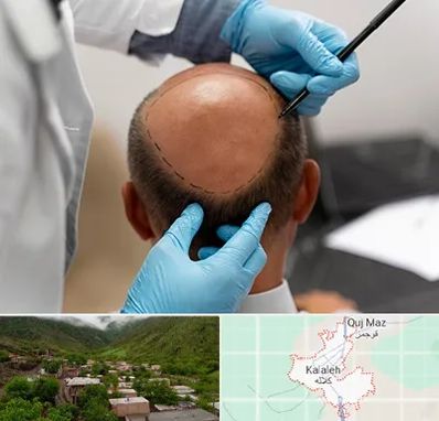 آموزش کاشت مو در کلاله