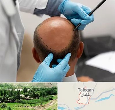 آموزش کاشت مو در طالقان