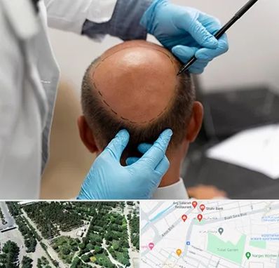 آموزش کاشت مو در سالاریه قم